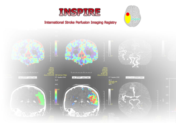 International Stroke Perfusion Imaging Registry (INSPIRE)